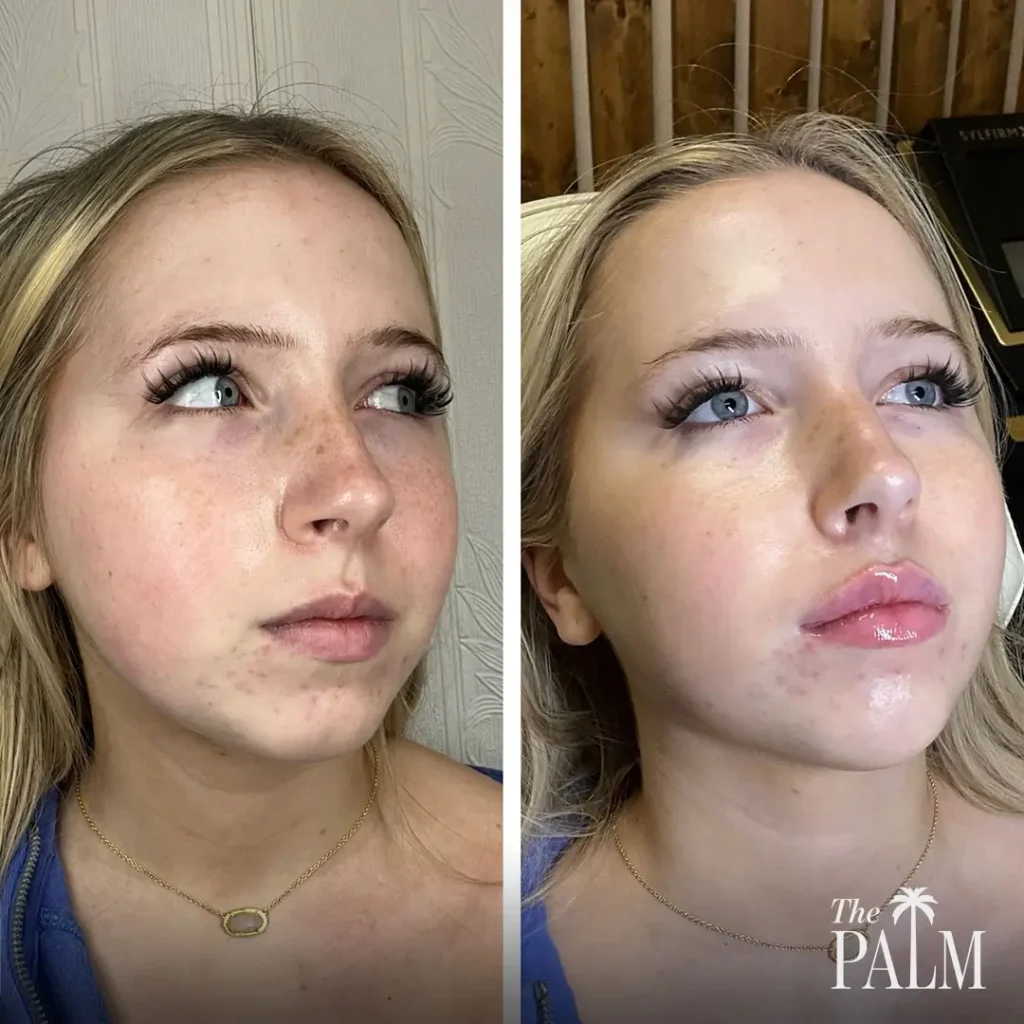Chin Filler