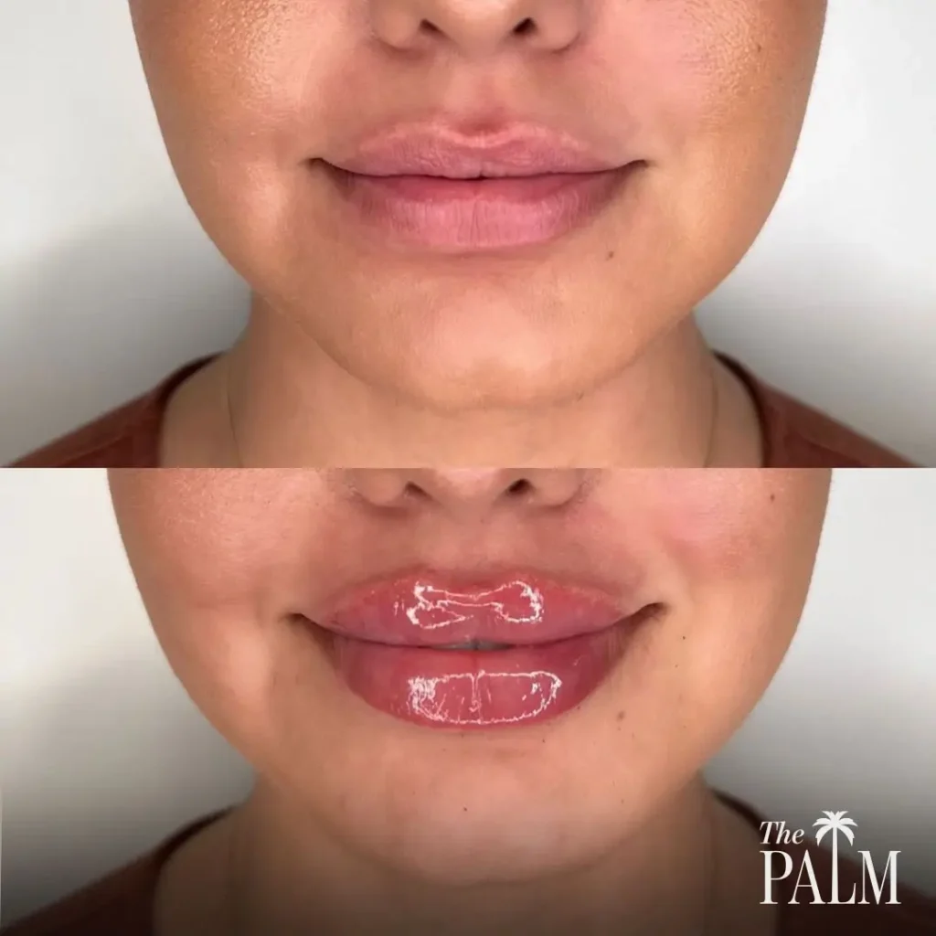 Lip Filler