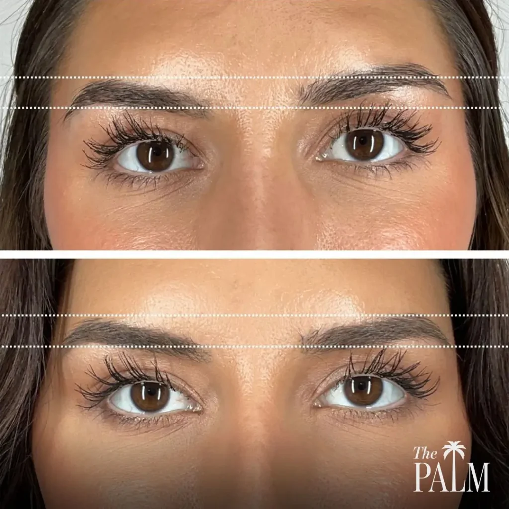 Neurotoxin Brow Lift