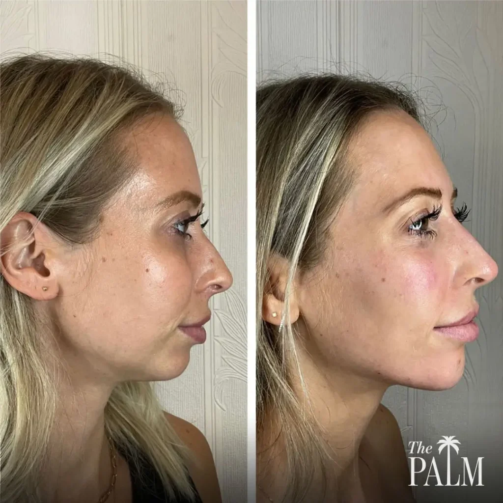 Sylfirm + Facial Balancing