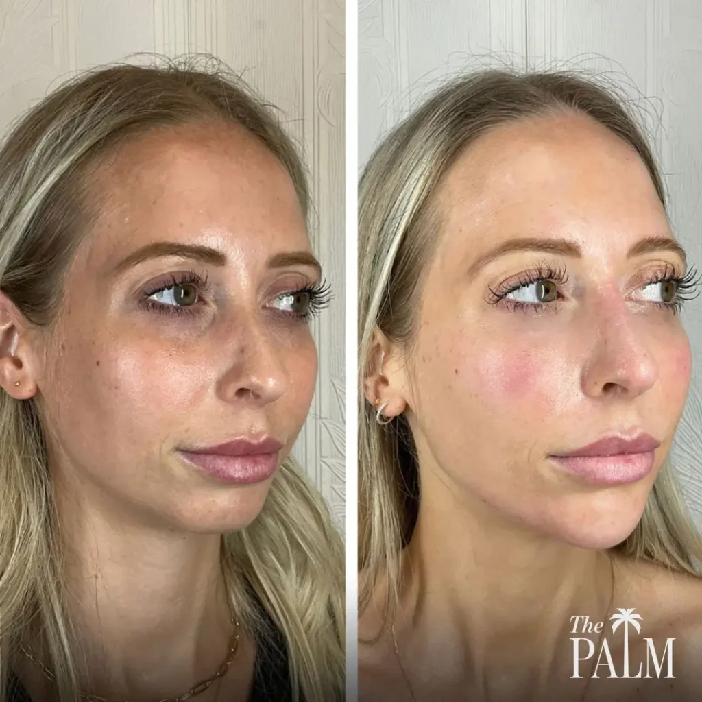 Sylfirm + Facial Balancing