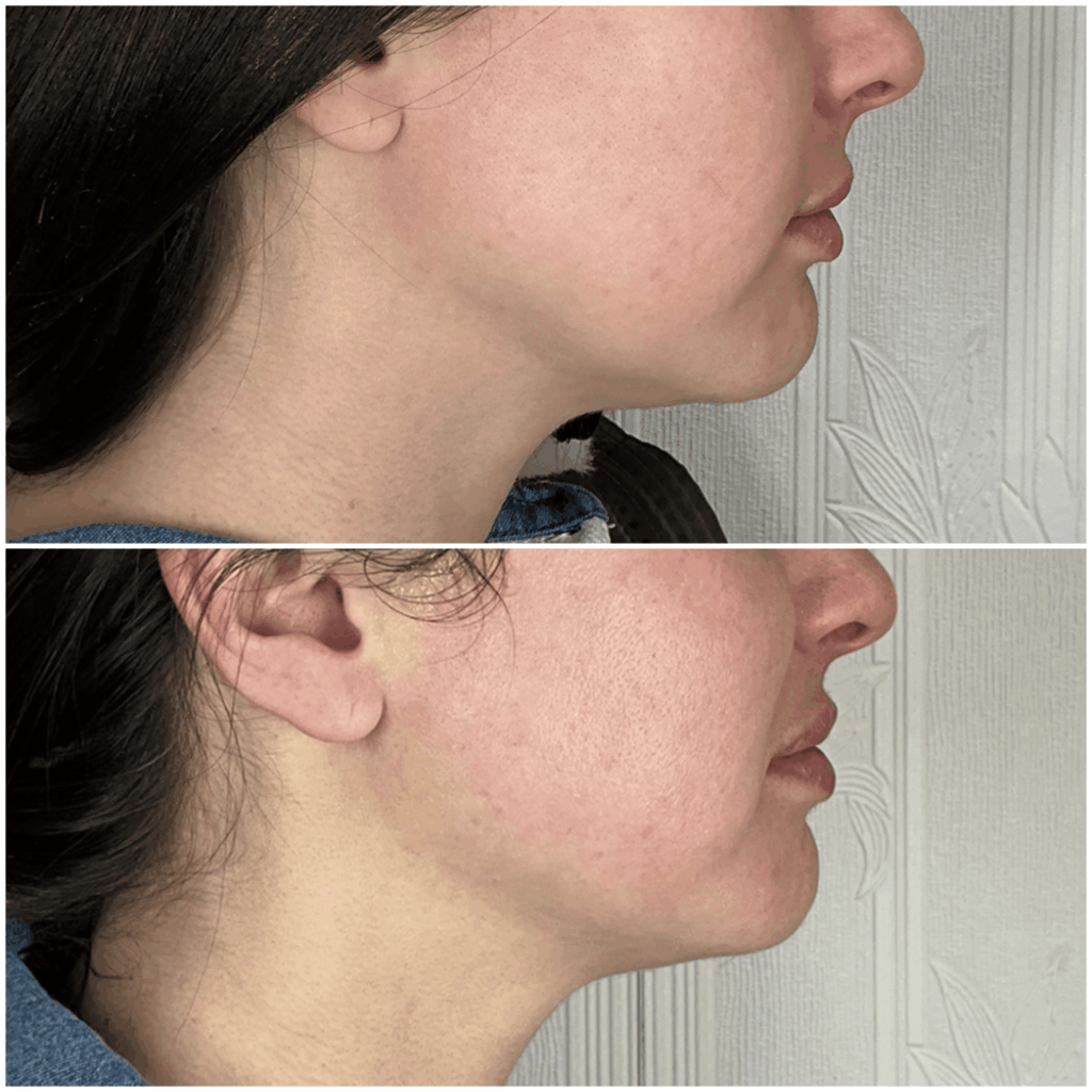Jawline Filler