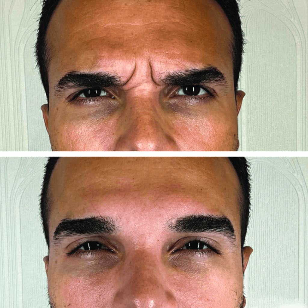 Brow Neurotoxin