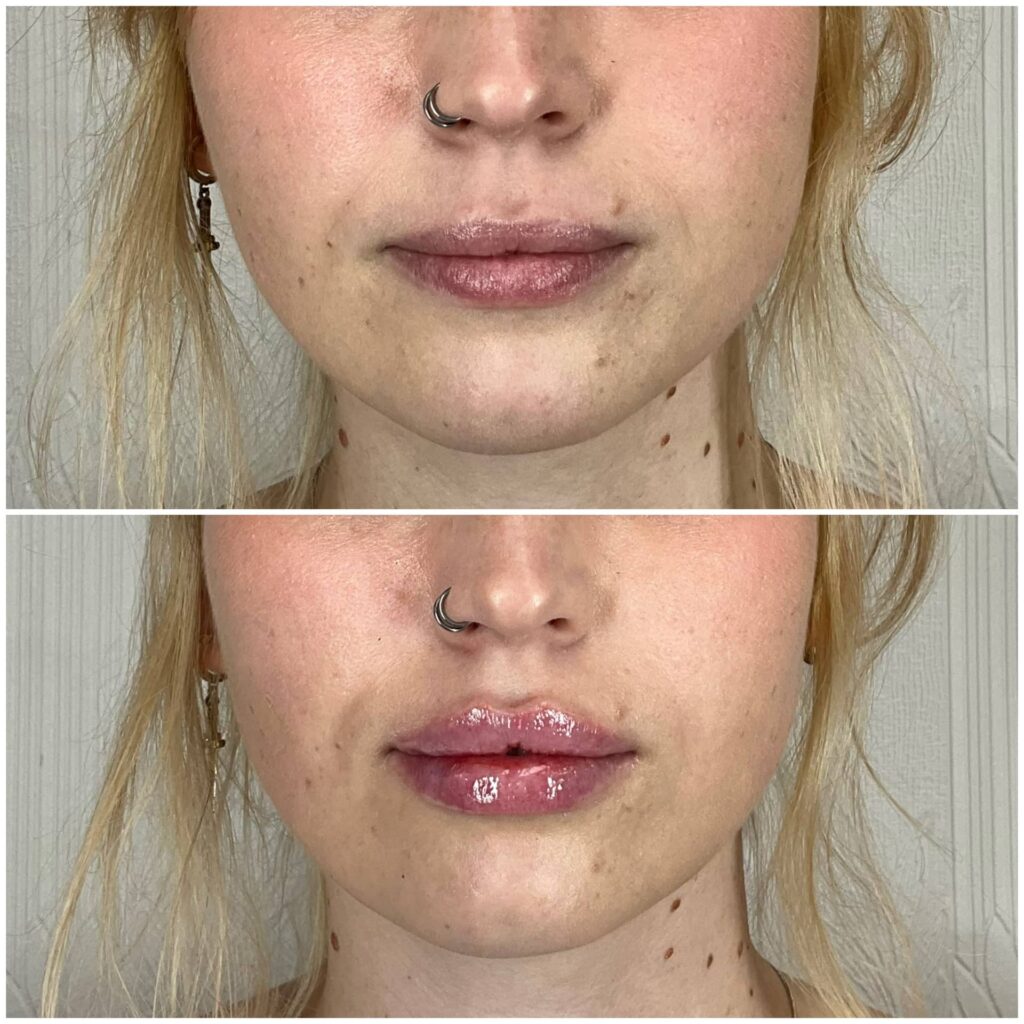 Lip Filler