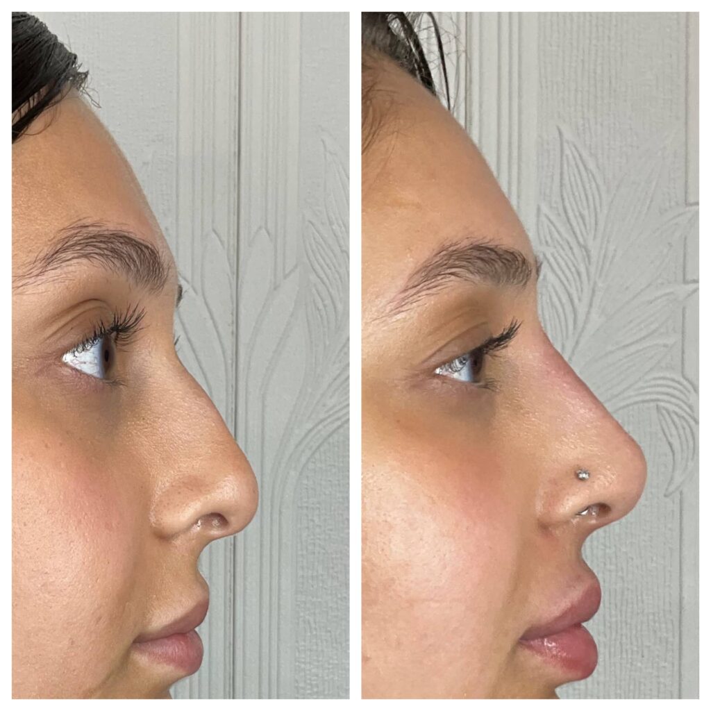 Non-surgical Nose Job