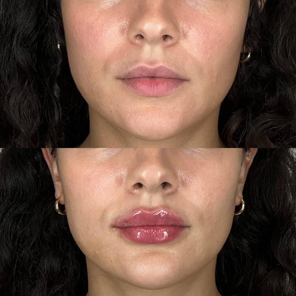 Lip Filler