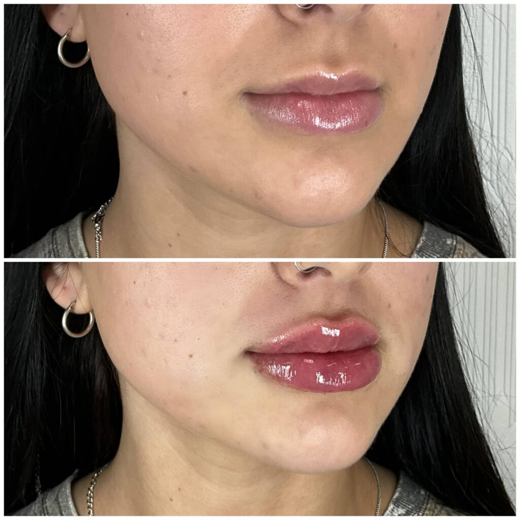 Lip Filler