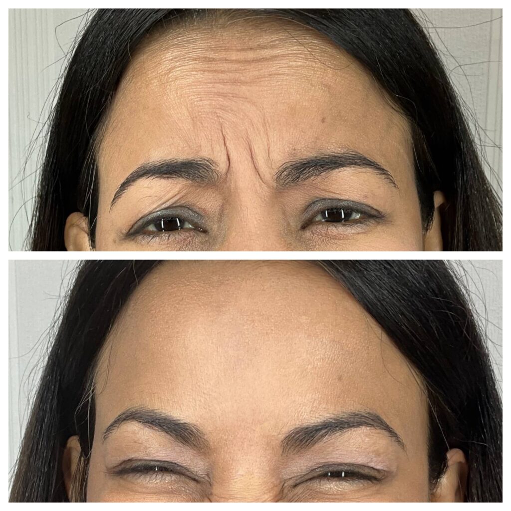 Neurotoxin forehead before and after