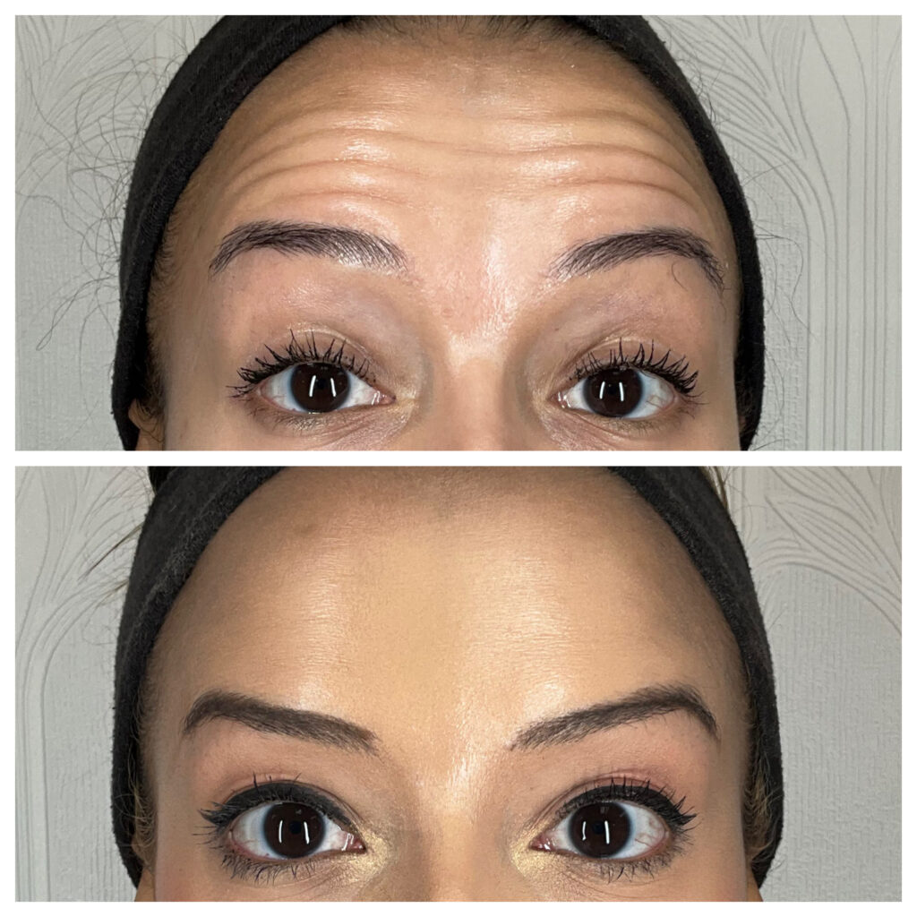 Neurotoxin before and after