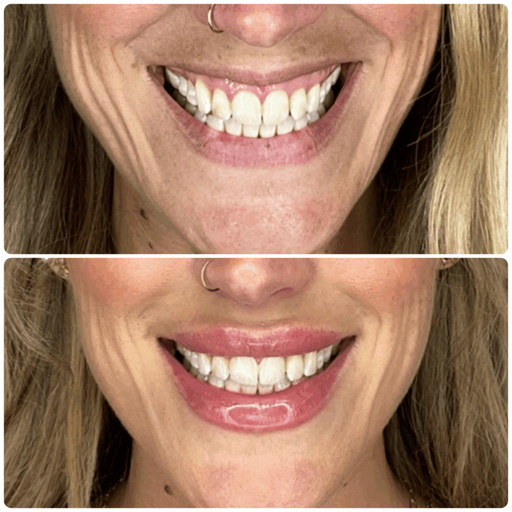 lip filler